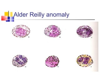 Alder Reilly anomaly
 