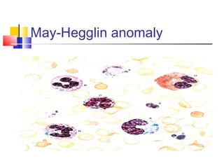 May-Hegglin anomaly
 