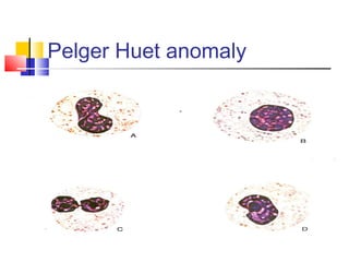 Pelger Huet anomaly
 