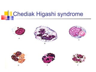 Chediak Higashi syndrome
 