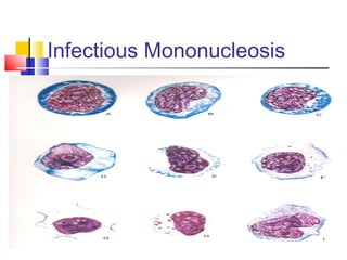 Infectious Mononucleosis
 