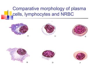 Comparative morphology of plasma
cells, lymphocytes and NRBC
 