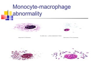 Monocyte-macrophage
abnormality
 