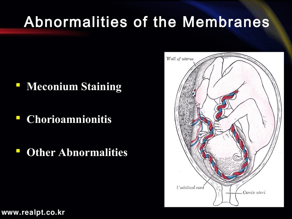 Abnormalities Of The Placenta Umbilical Cord And Memb vrogue.co