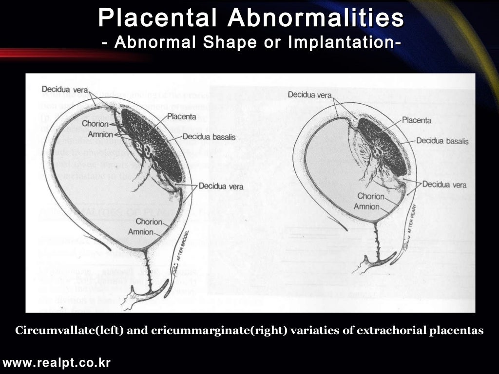 Abnormalities of the Placenta, Umbilical Cord and Membranes