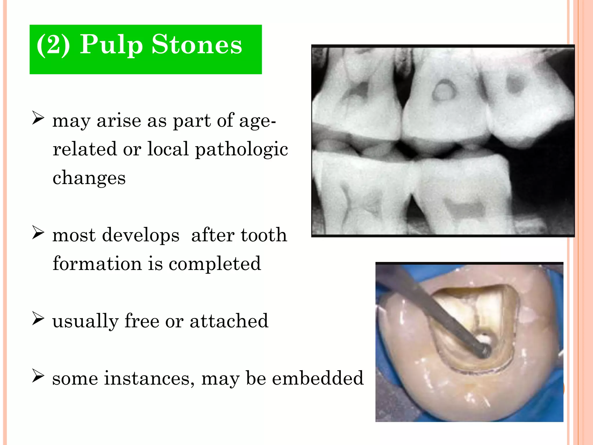 Pulpstone Radiograph Abnormalities of the pulp | PPT