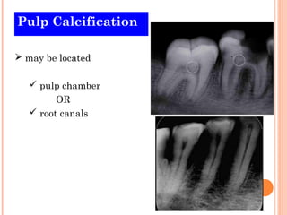 Pulp Calcification

 may be located

    pulp chamber
         OR
    root canals
 