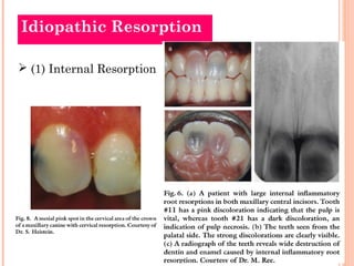 Idiopathic Resorption

 (1) Internal Resorption
 