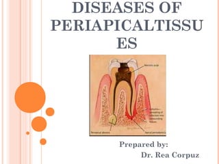 DISEASES OF
PERIAPICALTISSU
      ES




      Prepared by:
           Dr. Rea Corpuz
 