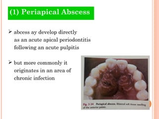 (1) Periapical Abscess

 abcess ay develop directly
  as an acute apical periodontitis
  following an acute pulpitis

 b...