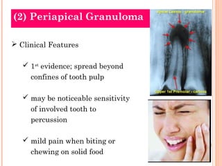 (2) Periapical Granuloma

 Clinical Features

    1st evidence; spread beyond
     confines of tooth pulp

    may be n...
