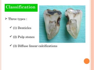 Classification

 Three types :

    (1) Denticles

    (2) Pulp stones

    (3) Diffuse linear calcifications
 