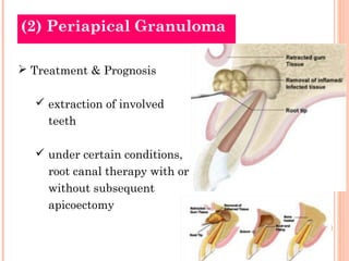 (2) Periapical Granuloma

 Treatment & Prognosis

   extraction of involved
     teeth

   under certain conditions,
  ...