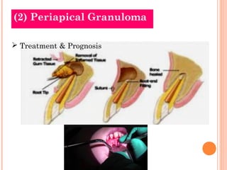 (2) Periapical Granuloma

 Treatment & Prognosis
 