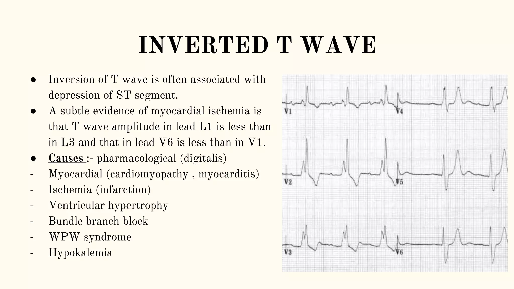 Abnormalities of t wave | PPT