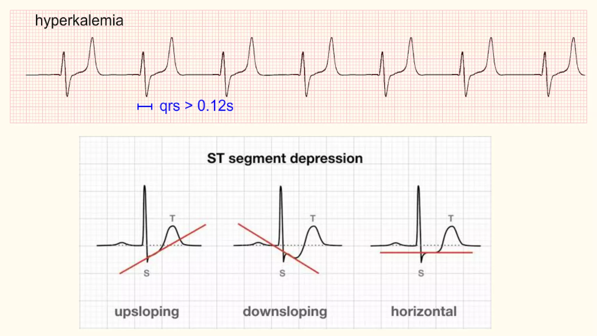 Abnormalities of t wave