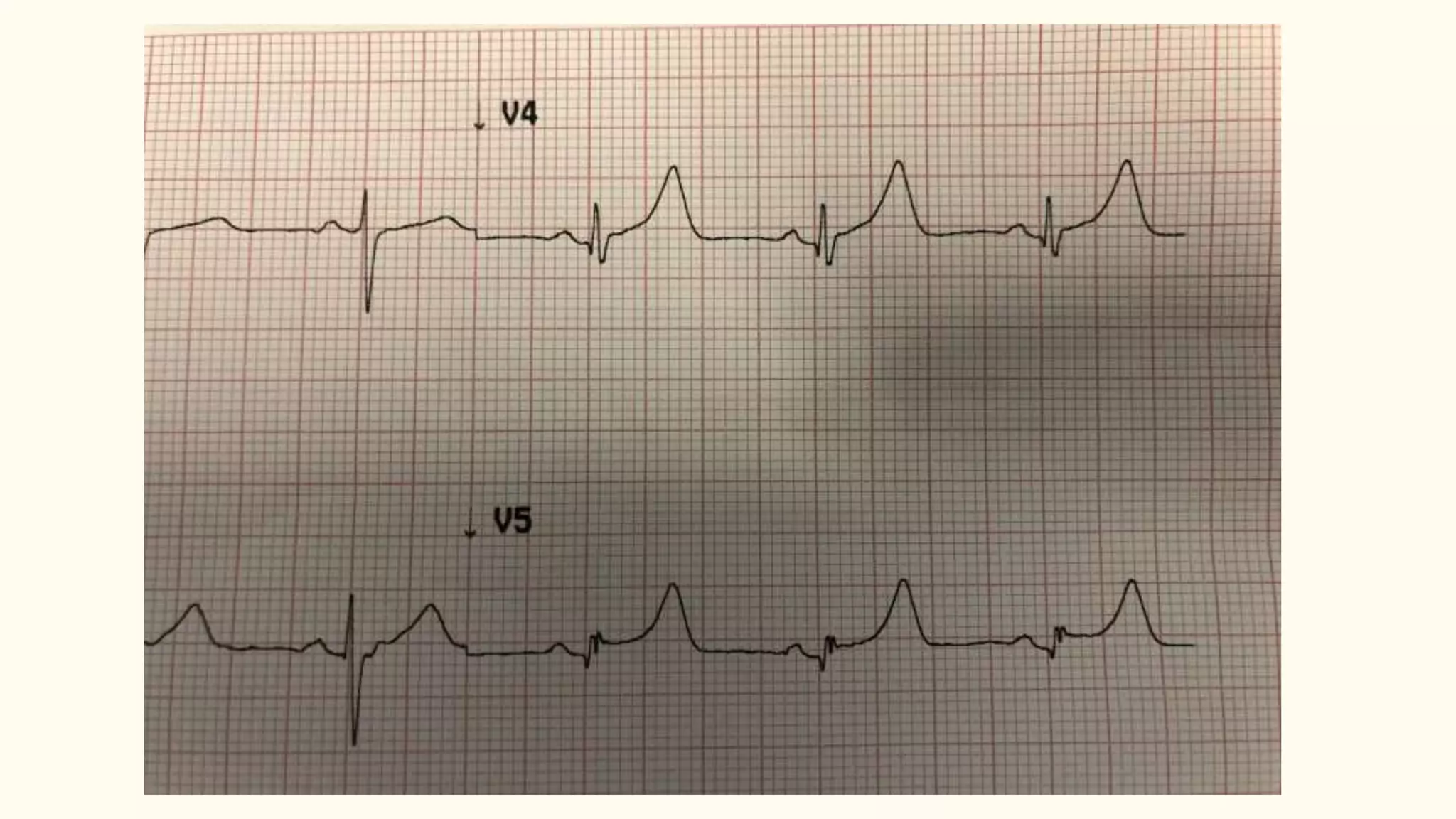 Abnormalities of t wave