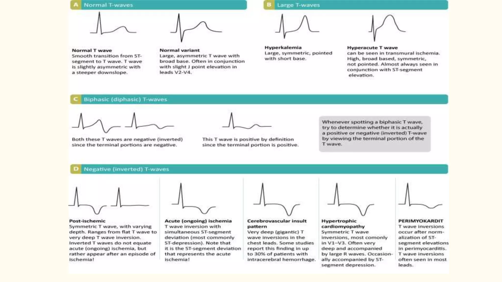 Abnormalities of t wave