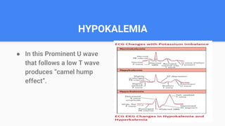 HYPOKALEMIA
● In this Prominent U wave
that follows a low T wave
produces “camel hump
effect”.
 
