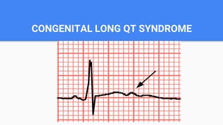 CONGENITAL LONG QT SYNDROME
 