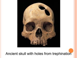 Ancient skull with holes from trephination
 