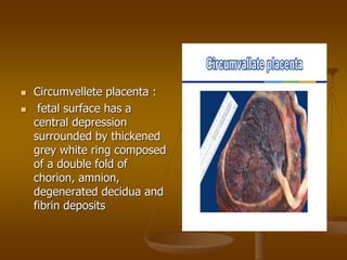 Chorionic Ring Abnormality of amniotic fluid and cord | PPT