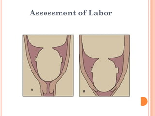 Abnormal Labor - obstructed labour and dystocia | PPT