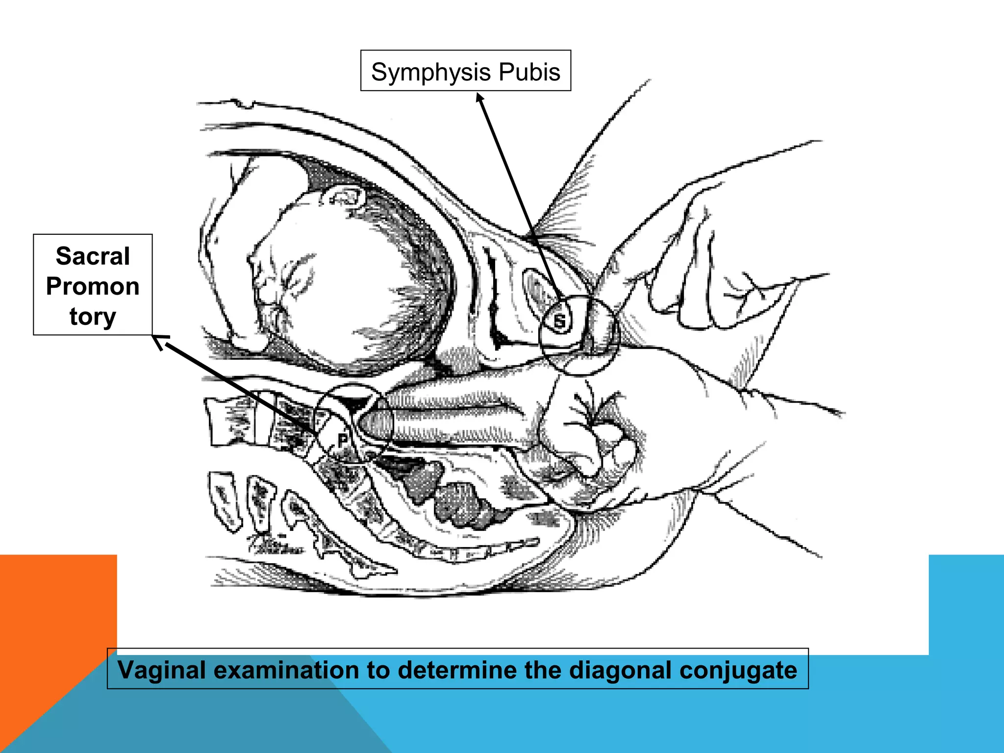 Sacral
Promon
tory
Vaginal examination to determine the diagonal conjugate
Symphysis Pubis
 