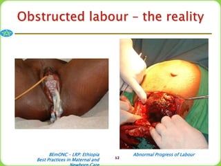 Abnormal labour..ppt