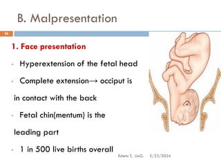 B. Malpresentation
5/23/2024
Eshetu T, UoG.
26
1. Face presentation
• Hyperextension of the fetal head
• Complete extension→ occiput is
in contact with the back
• Fetal chin(mentum) is the
leading part
• 1 in 500 live births overall
 