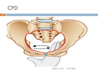 CPD
5/23/2024
Eshetu T, UoG.
79
 