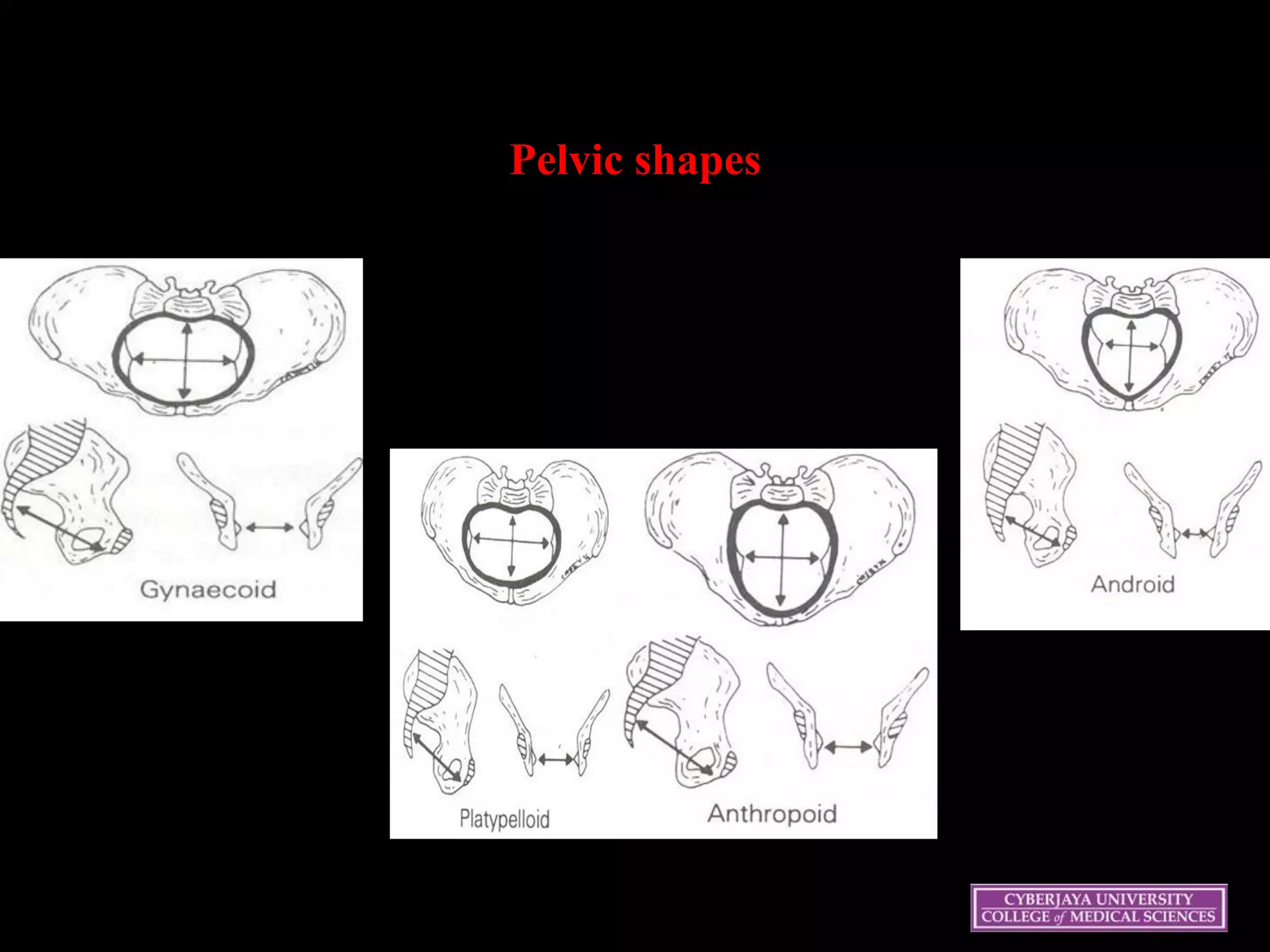 Pelvic shapes
 