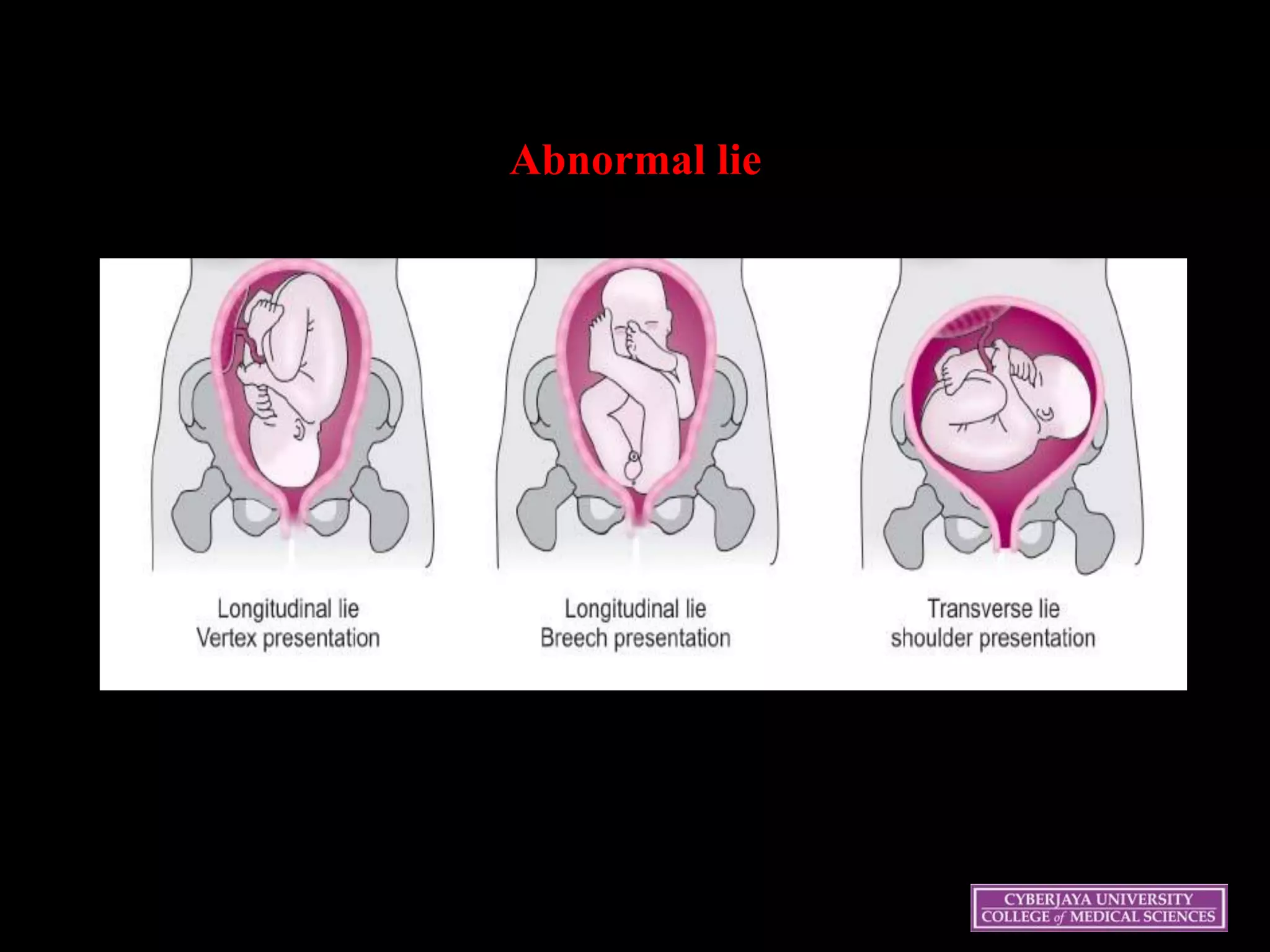 Abnormal lie
 