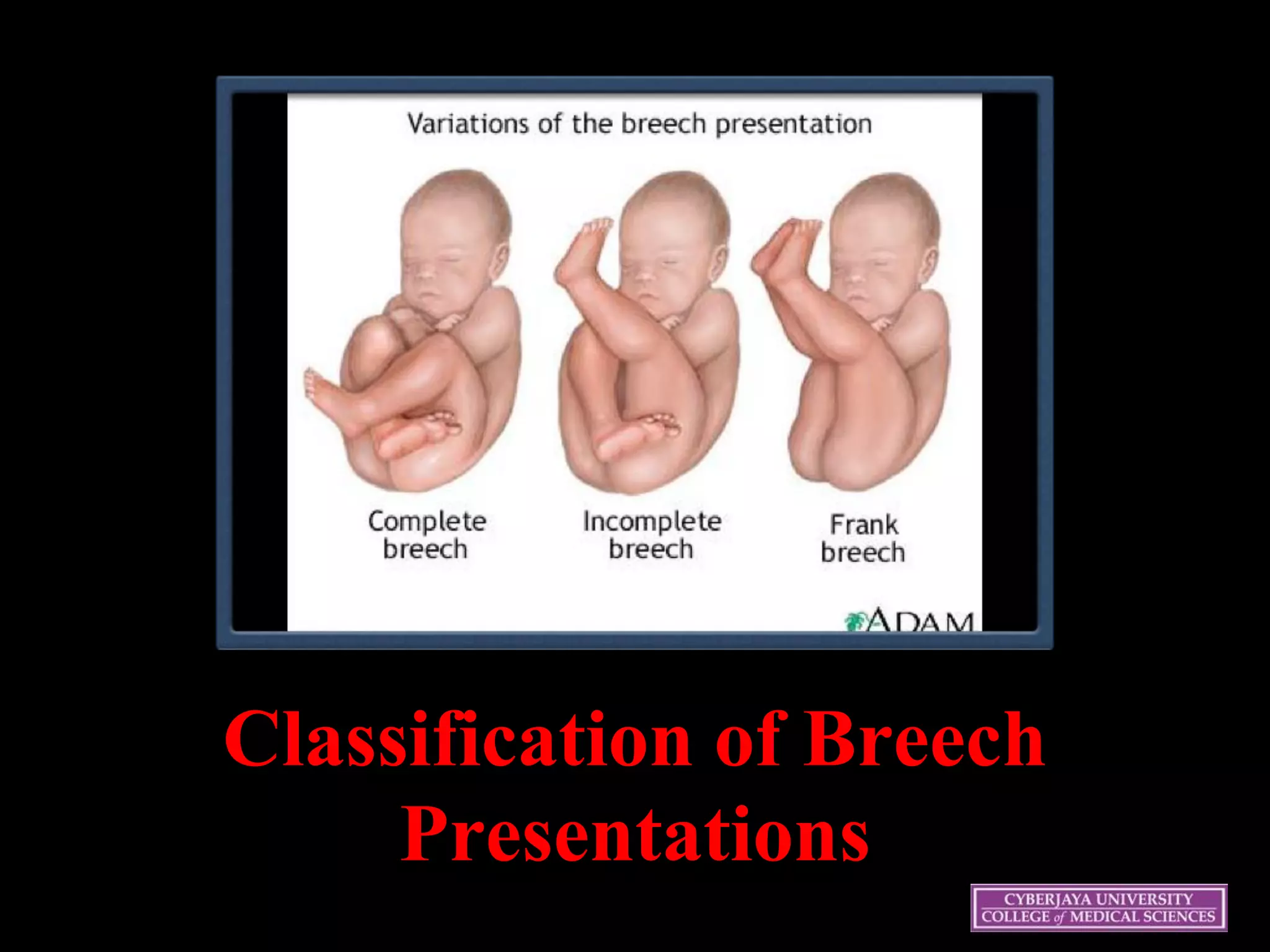 21
Classification of Breech
Presentations
 