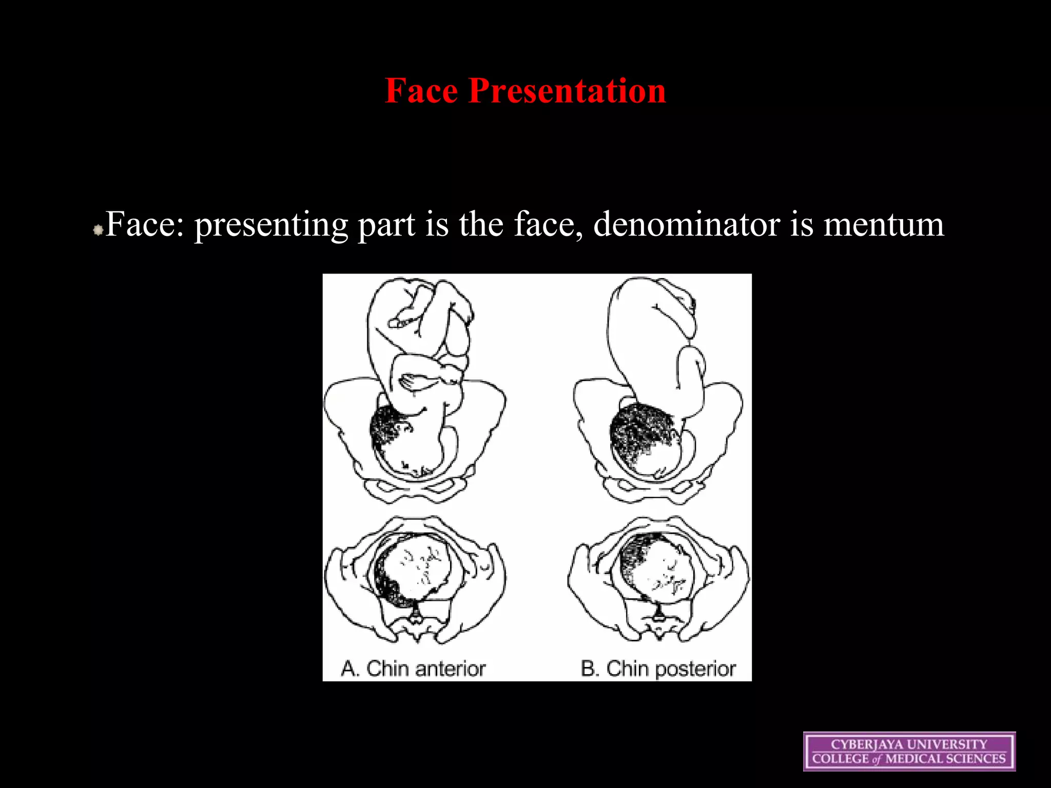 22
Face Presentation
Face: presenting part is the face, denominator is mentum
 