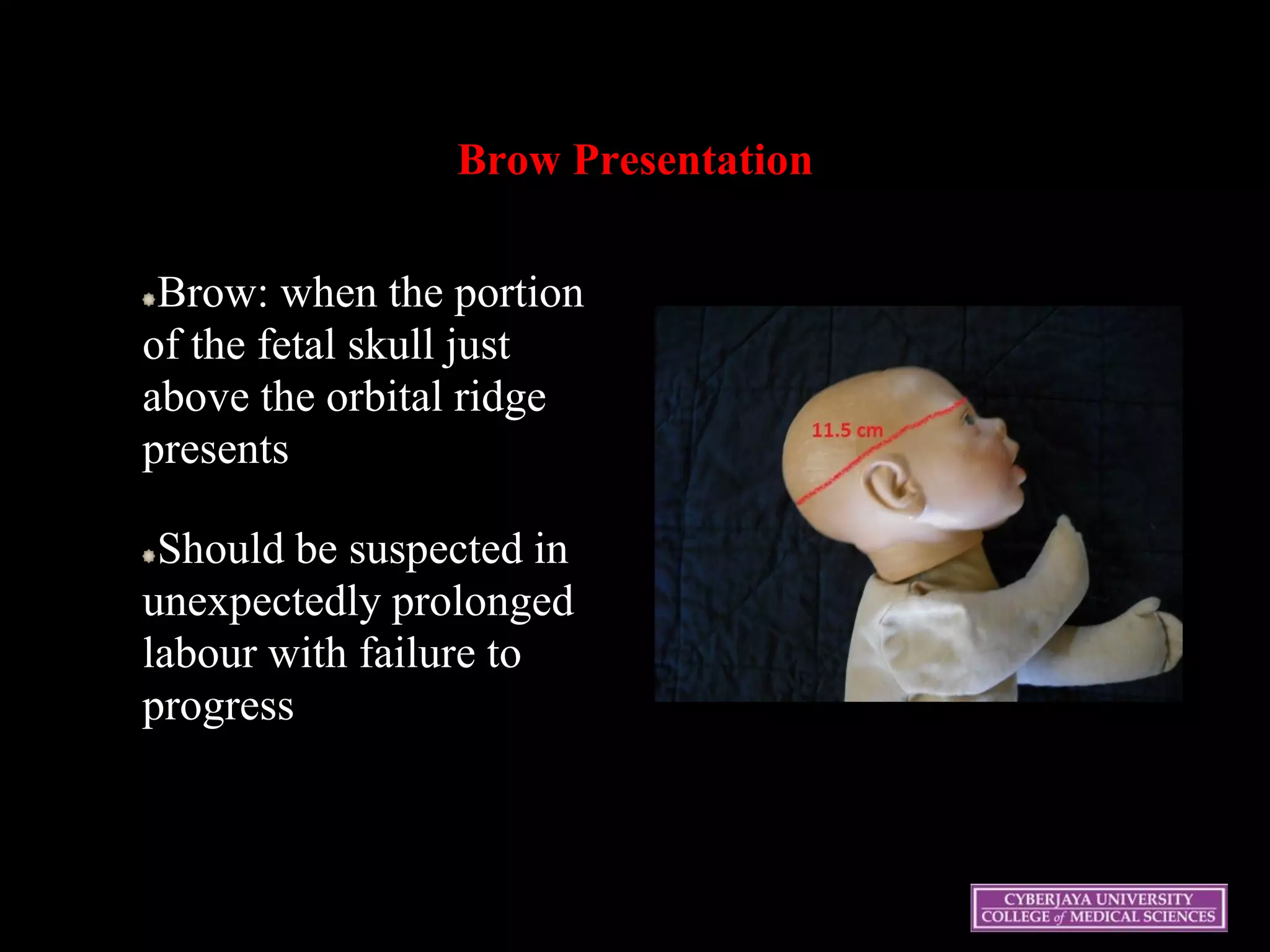Brow Presentation
Brow: when the portion
of the fetal skull just
above the orbital ridge
presents
Should be suspected in
unexpectedly prolonged
labour with failure to
progress
23
 