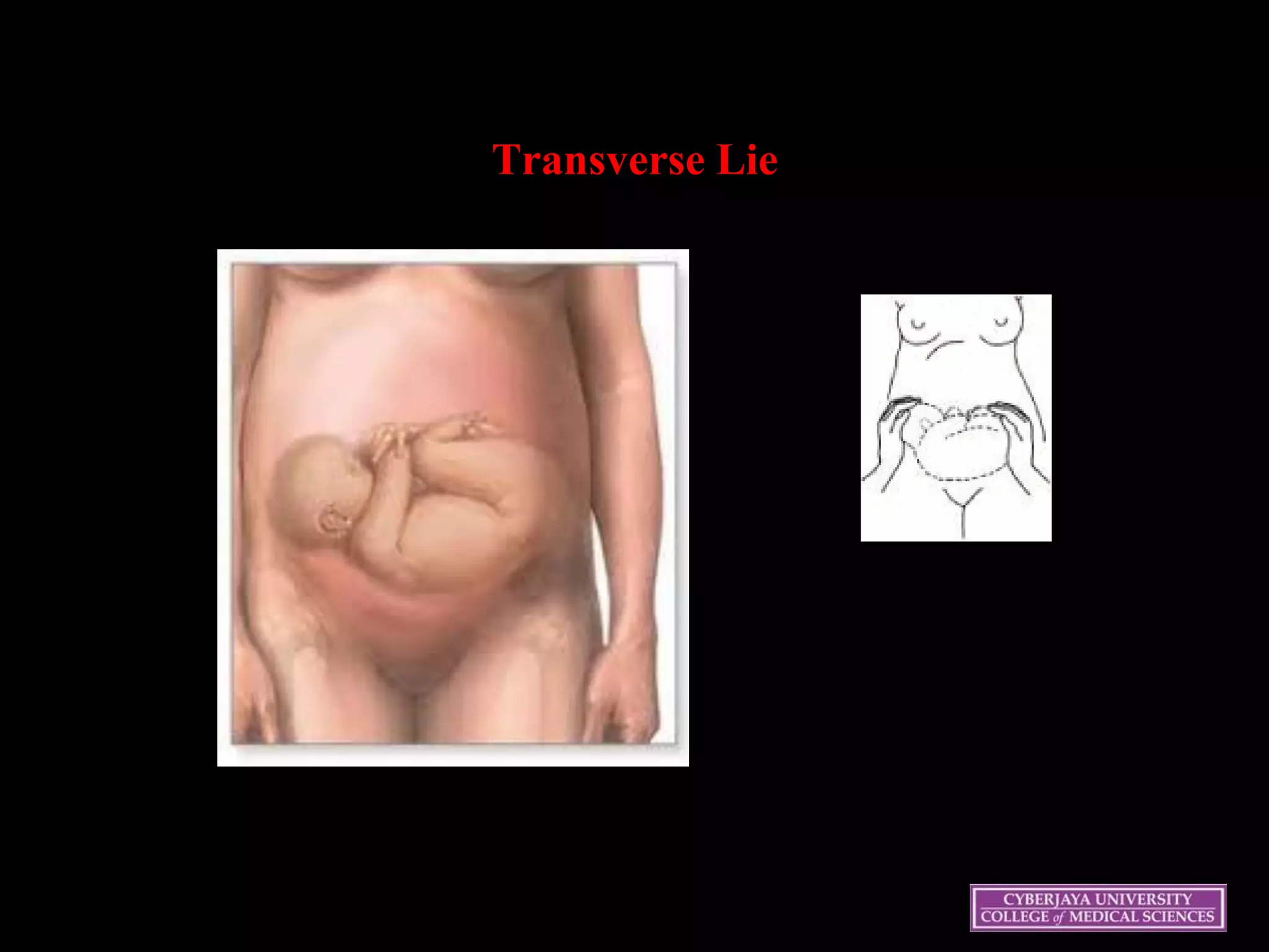 Transverse Lie
 