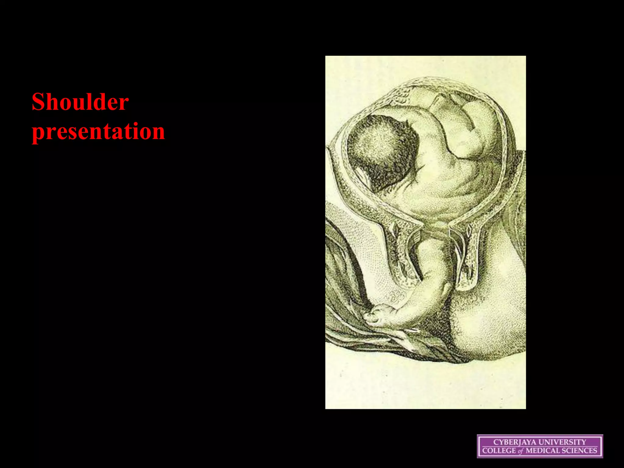 Shoulder
presentation
 