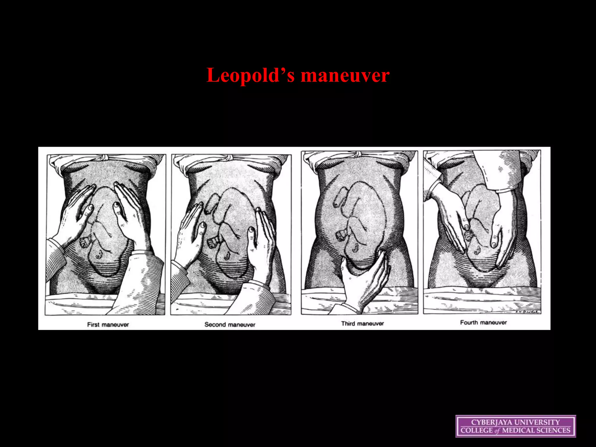 Leopold’s maneuver
 