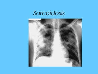 Sarcoidosis
 