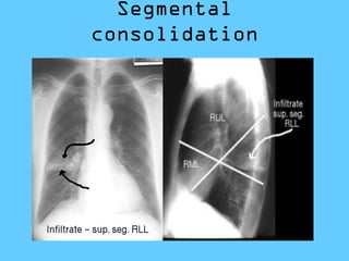 Segmental
consolidation
 