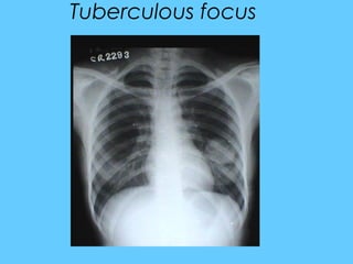 Tuberculous focus
 