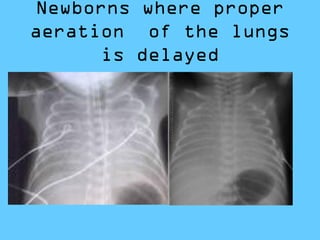 Newborns where proper
aeration of the lungs
is delayed
 