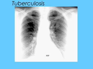 Tuberculosis
 