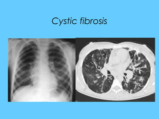 Cystic fibrosis
 