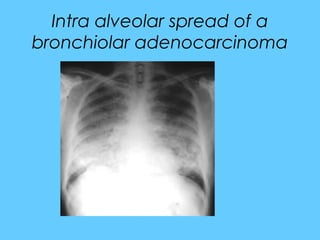 Intra alveolar spread of a
bronchiolar adenocarcinoma
 