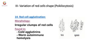 Variation In Rbc Shape Abnormal morphology of rbc notes | PDF