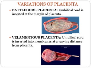 VARIATIONS OF PLACENTA
 BATTLEDORE PLACENTA: Umbilical cord is
inserted at the margin of placenta.
 VELAMENTOUS PLACENTA: Umbilical cord
is inserted into membranes at a varying distance
from placenta.
 