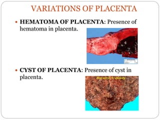 VARIATIONS OF PLACENTA
 HEMATOMA OF PLACENTA: Presence of
hematoma in placenta.
 CYST OF PLACENTA: Presence of cyst in
placenta.
 