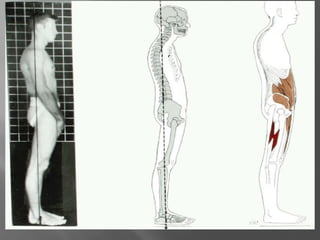 Abnormal posture in human body biomechanics.pdf